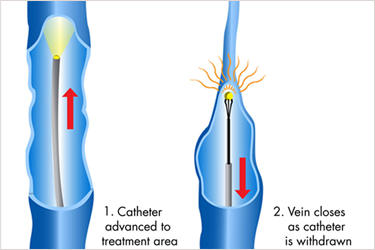 Catheters