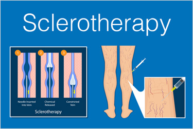 Catheters